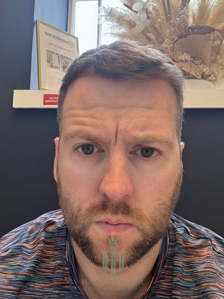 Hair transplant result, 2,700 grafts, Month 4 — Hair of Istanbul