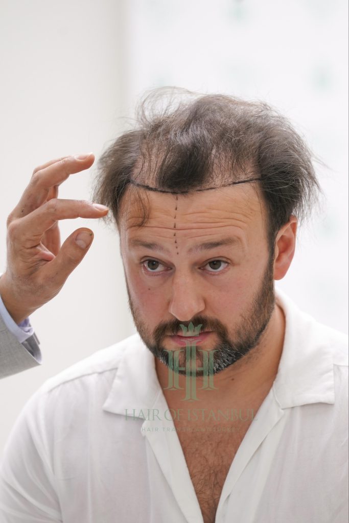 Hair transplant result, 4,300 grafts, Before (4) — Hair of Istanbul