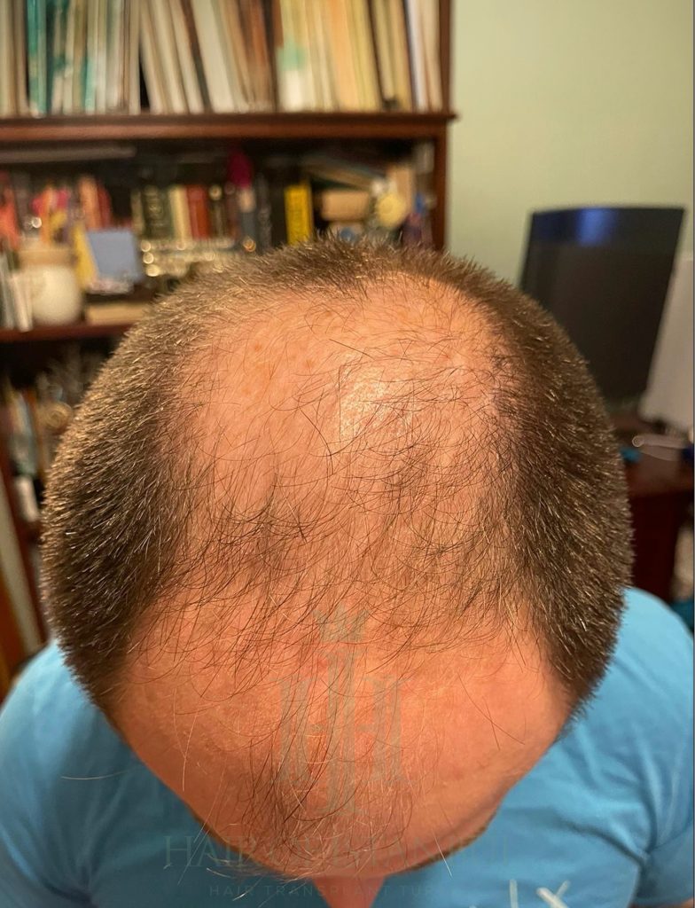 Hair transplant result, 4,450 grafts, Before (4) — Hair of Istanbul