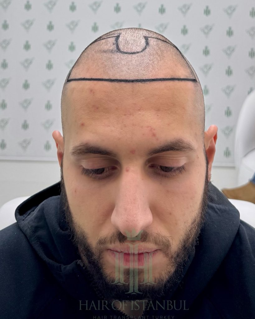 Hair transplant result, 4,500 grafts, Hairline design — Hair of Istanbul