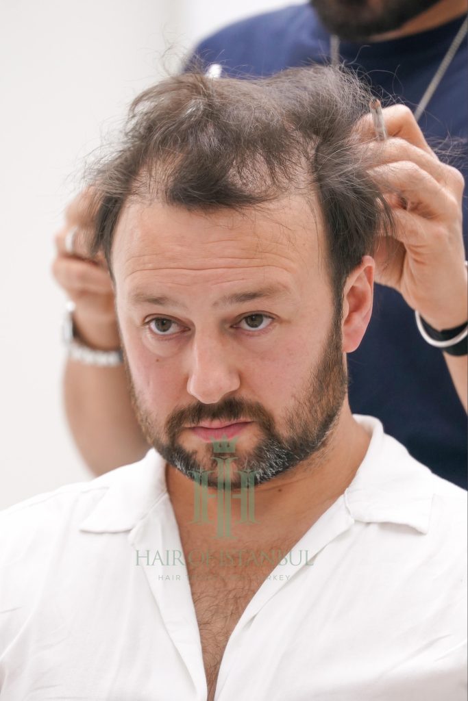 Hair transplant result, 4,300 grafts, Before (3) — Hair of Istanbul