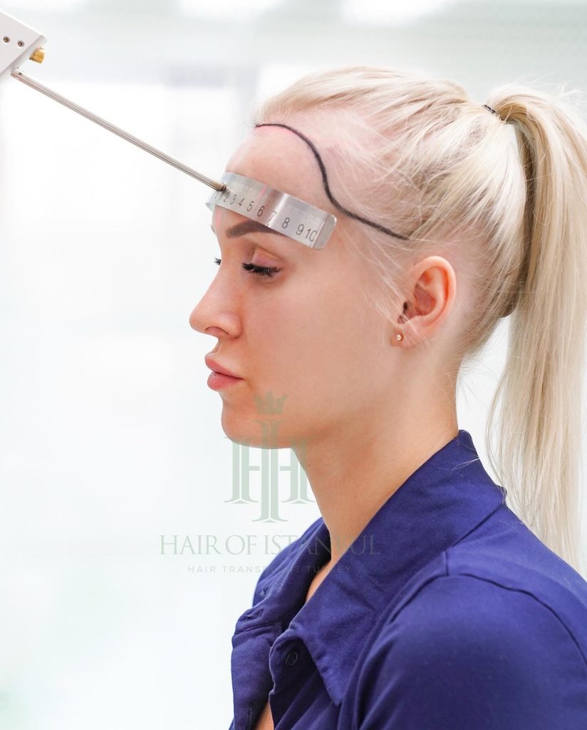 Women’s hair transplant result, 2,000 grafts, Hairline design — Hair of Istanbul