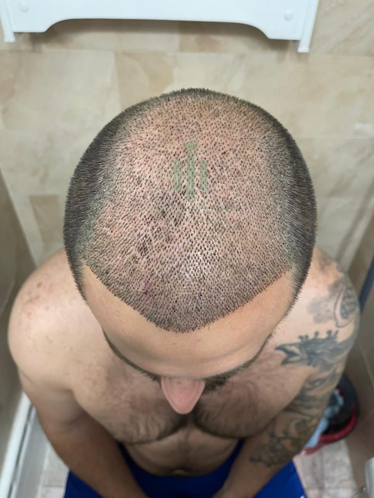 Hair transplant result, 4,450 grafts, Day 3 — Hair of Istanbul