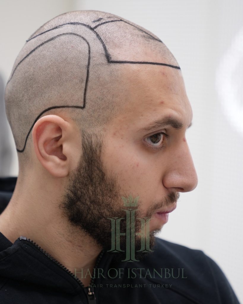Hair transplant result, 4,500 grafts, Hairline design (2) — Hair of Istanbul