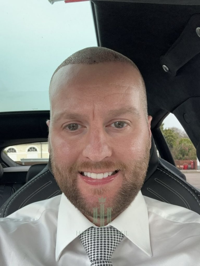 Hair transplant result, 2,700 grafts, Day 3 — Hair of Istanbul