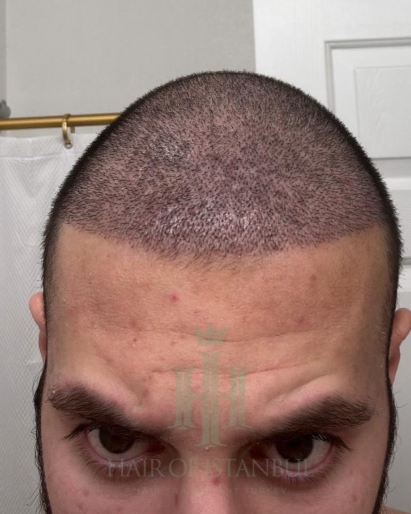 Hair transplant result, 4,500 grafts, Day 10 — Hair of Istanbul