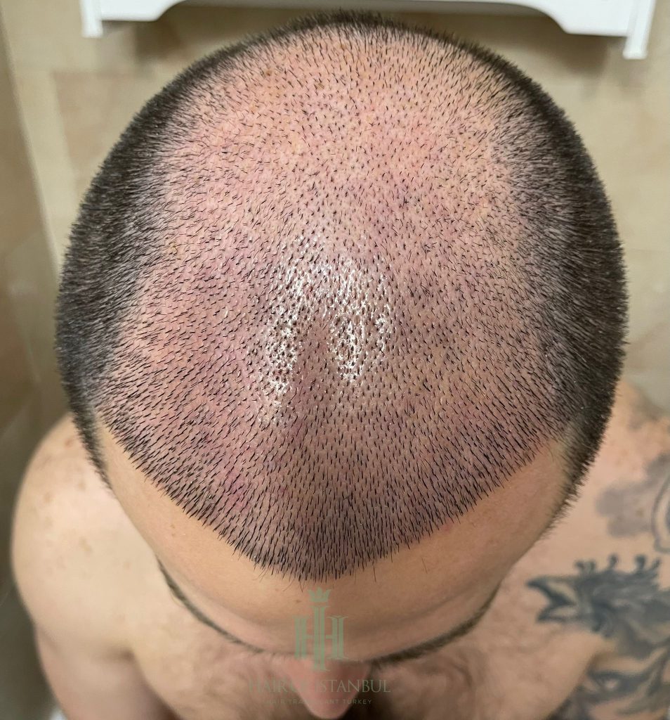 Hair transplant result, 4,450 grafts, Day 10 — Hair of Istanbul