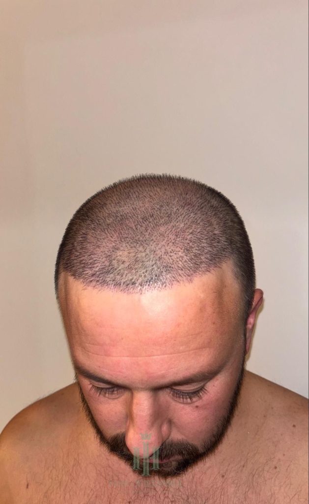 Hair transplant result, 4,300 grafts, Day 10 — Hair of Istanbul