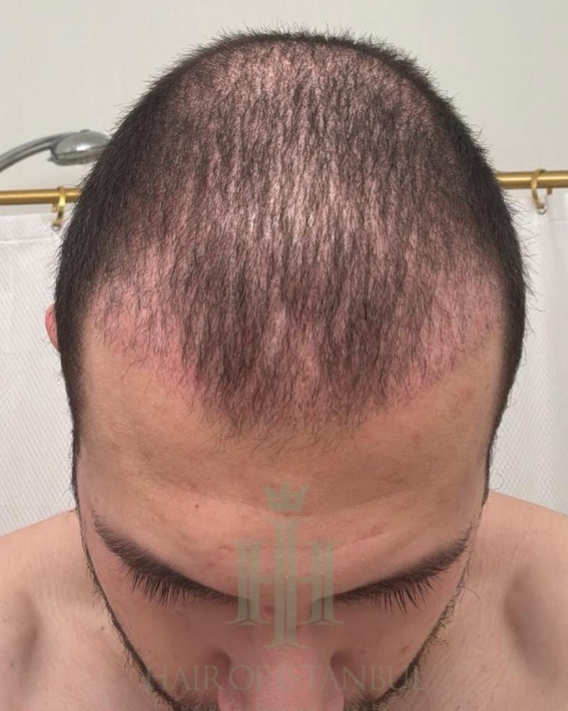 Hair transplant result, 4,500 grafts, Month 1 — Hair of Istanbul