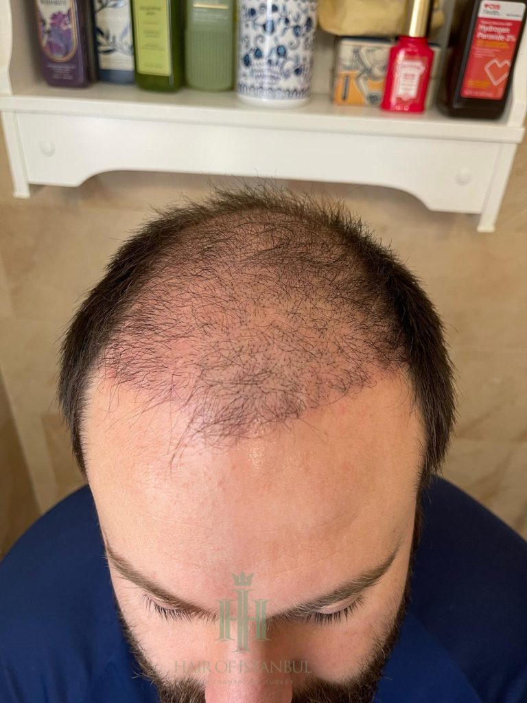 Hair transplant result, 4,450 grafts, Month 1 — Hair of Istanbul