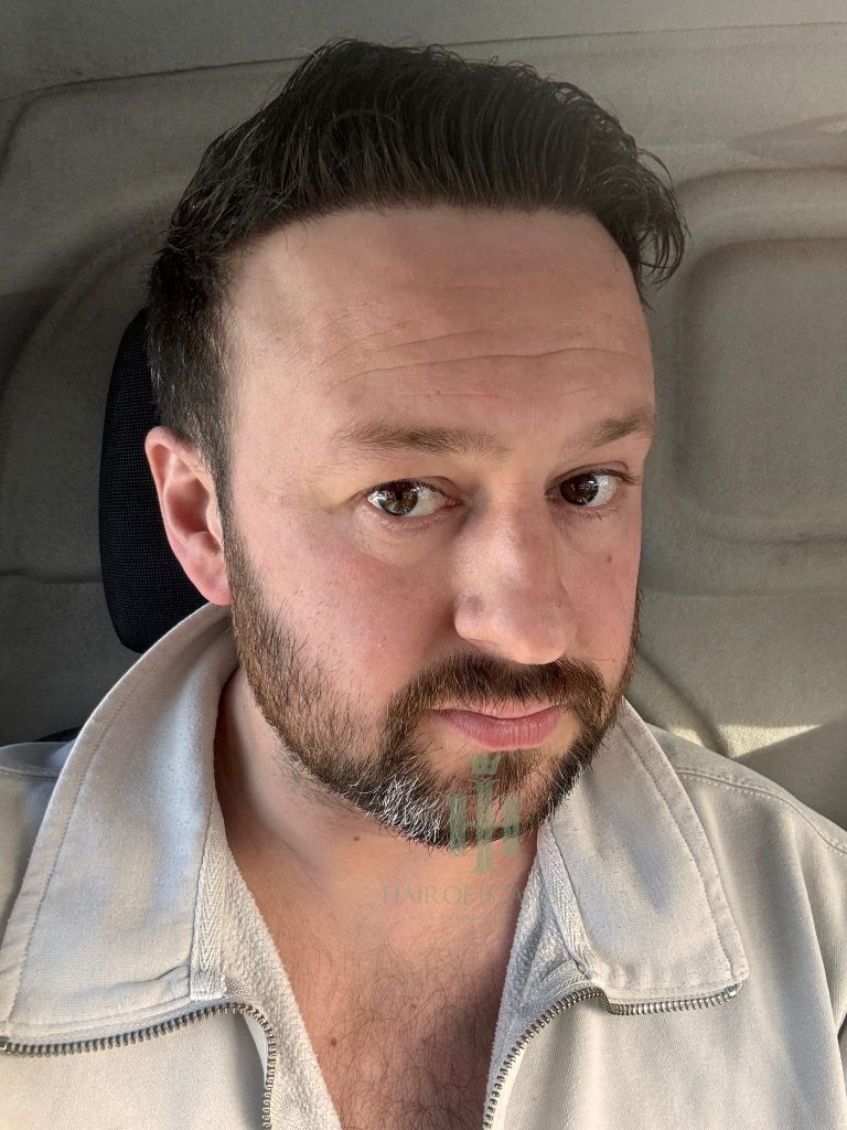 Hair transplant result, 4,300 grafts, Month 11 (2) — Hair of Istanbul