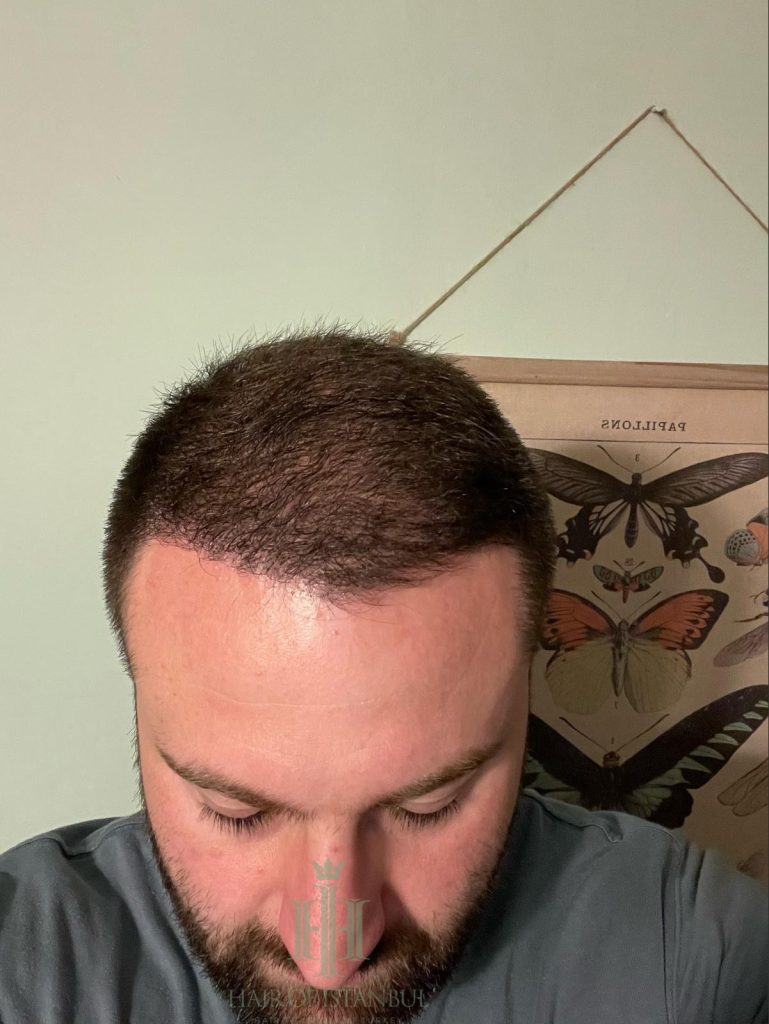Hair transplant result, 4,450 grafts, Month 4 — Hair of Istanbul