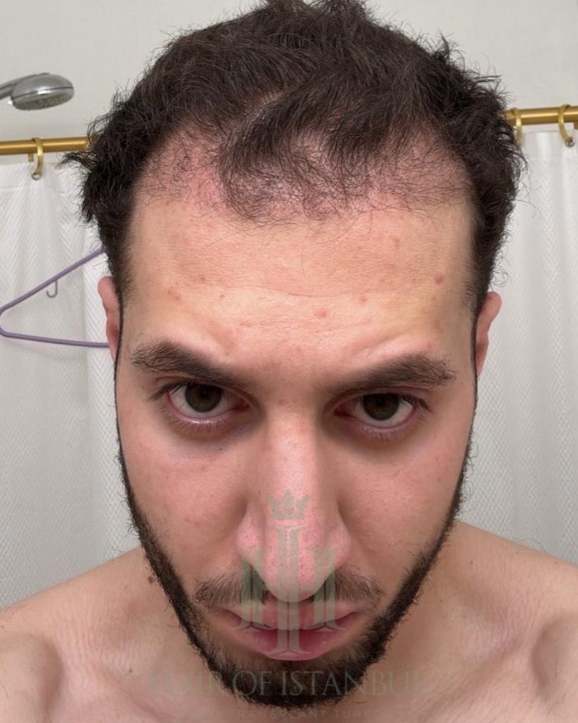 Hair transplant result, 4,500 grafts, Month 3 — Hair of Istanbul