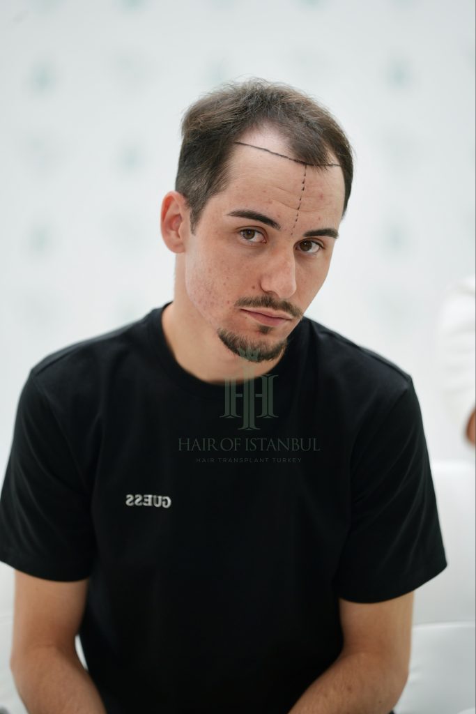 Hair transplant result, 3,100 grafts, Hairline design — Hair of Istanbul