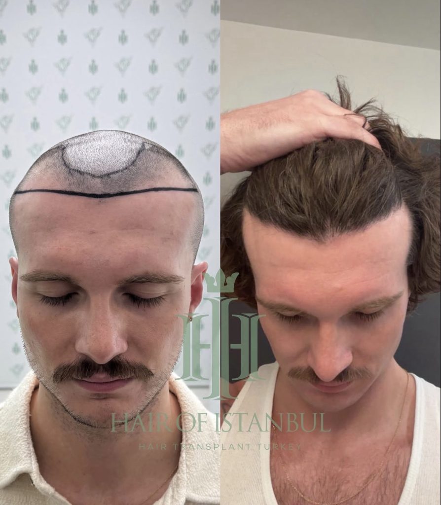 Hair transplant result, 2,500 grafts, Before & After — Hair of Istanbul