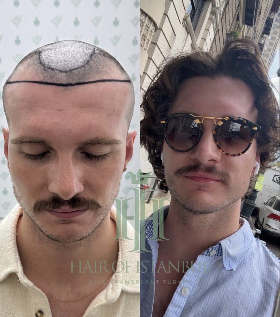 Hair transplant result, 2,500 grafts, Before & After (3) — Hair of Istanbul