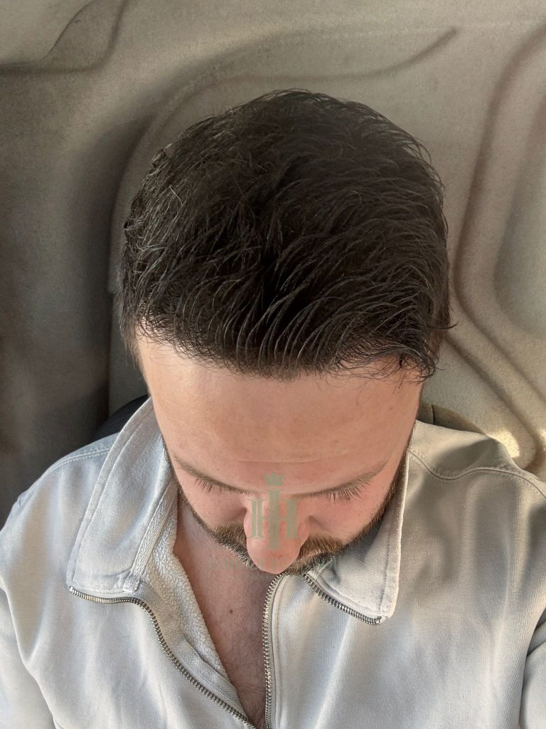 Hair transplant result, 4,300 grafts, Month 11 (3) — Hair of Istanbul