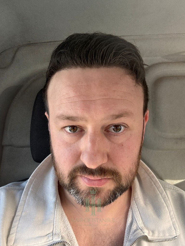 Hair transplant result, 4,300 grafts, Month 11 (4) — Hair of Istanbul