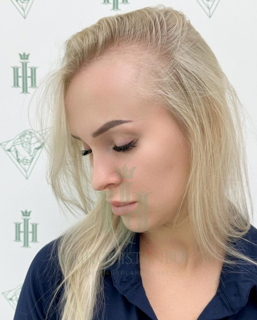 Women’s hair transplant result, 2,000 grafts, Before (2) — Hair of Istanbul