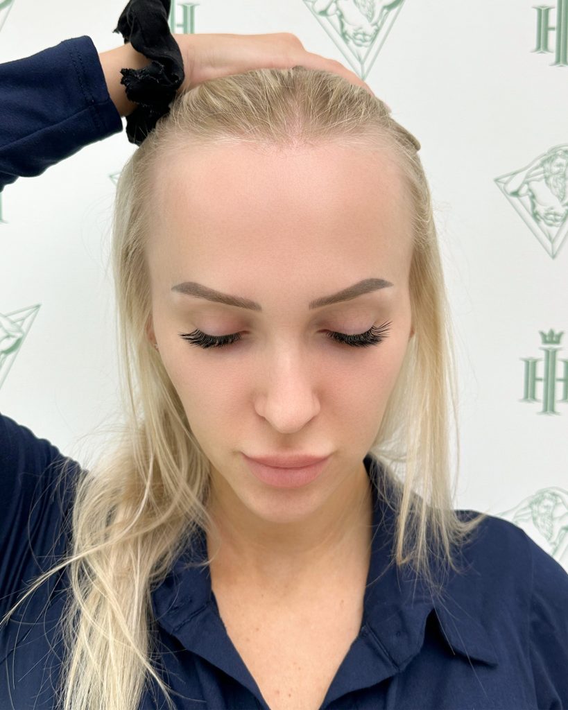 Women’s hair transplant result, 2,000 grafts, Before — Hair of Istanbul