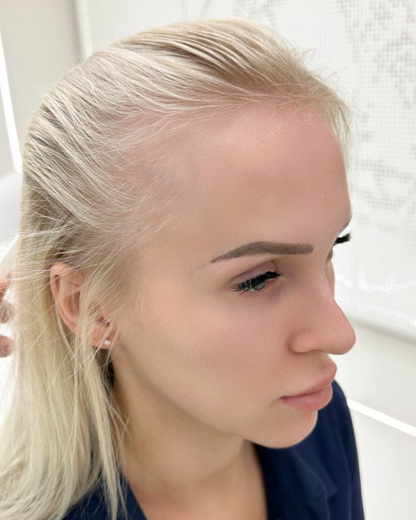 Women’s hair transplant result, 2,000 grafts, Before (3) — Hair of Istanbul