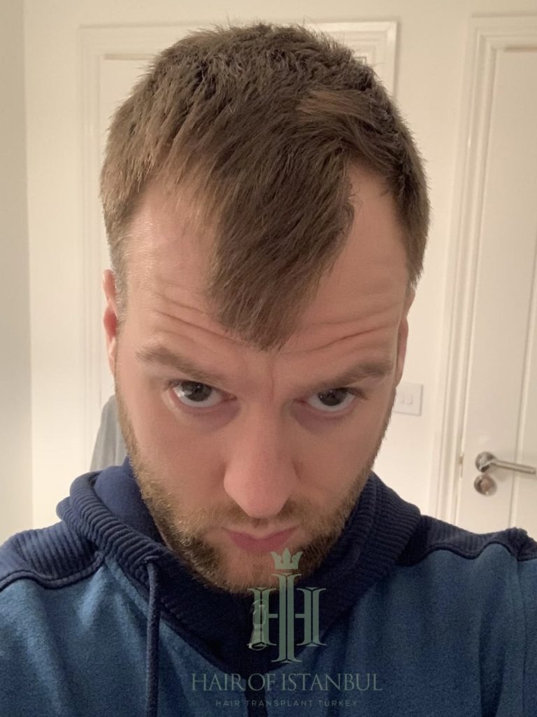 Hair transplant result, 2,700 grafts, Before — Hair of Istanbul