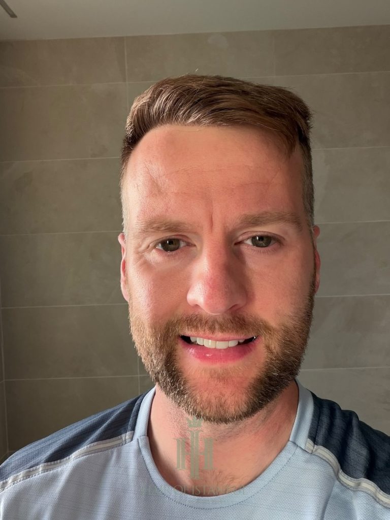 Hair transplant result, 2,700 grafts, Month 12 — Hair of Istanbul