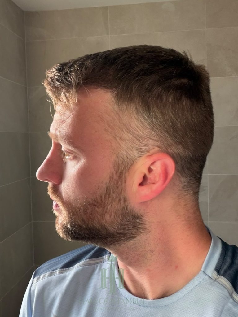 Hair transplant result, 2,700 grafts, Before & After (3) — Hair of Istanbul