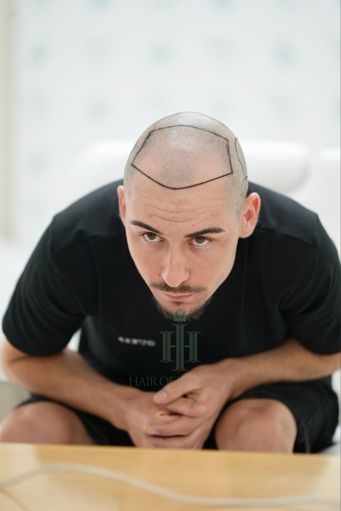 Hair transplant result, 3,100 grafts, Hairline design (2) — Hair of Istanbul