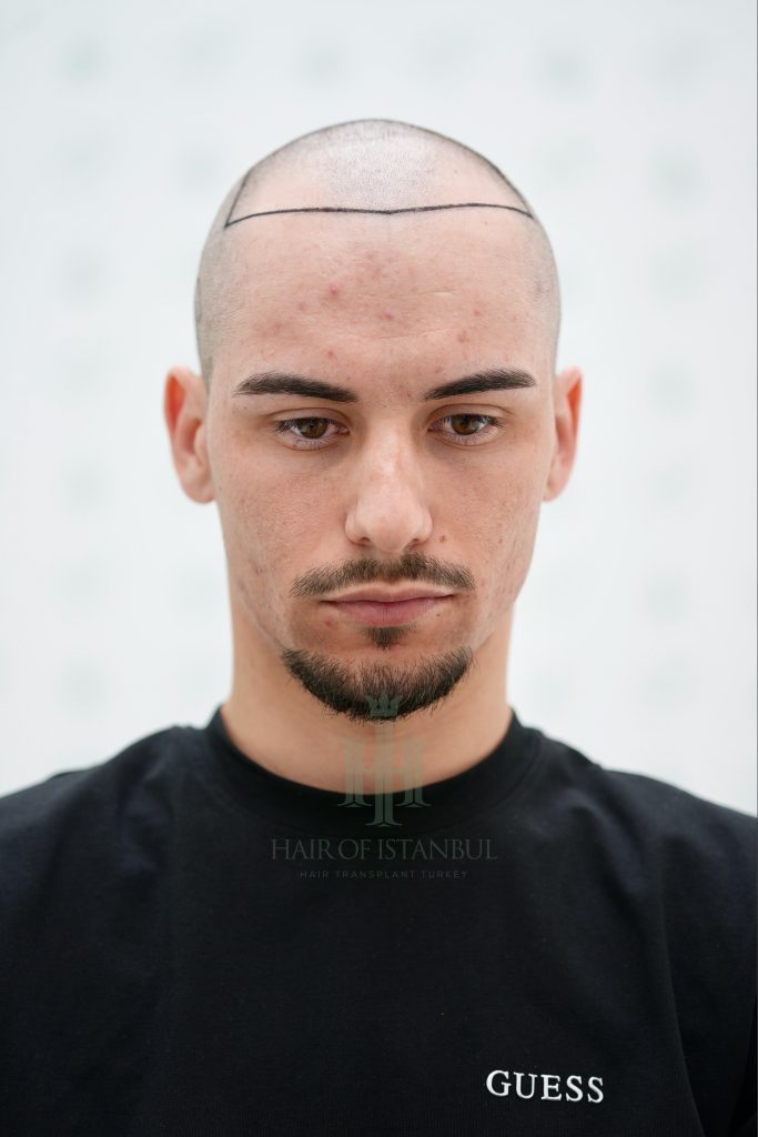 Hair transplant result, 3,100 grafts, Hairline design (3) — Hair of Istanbul