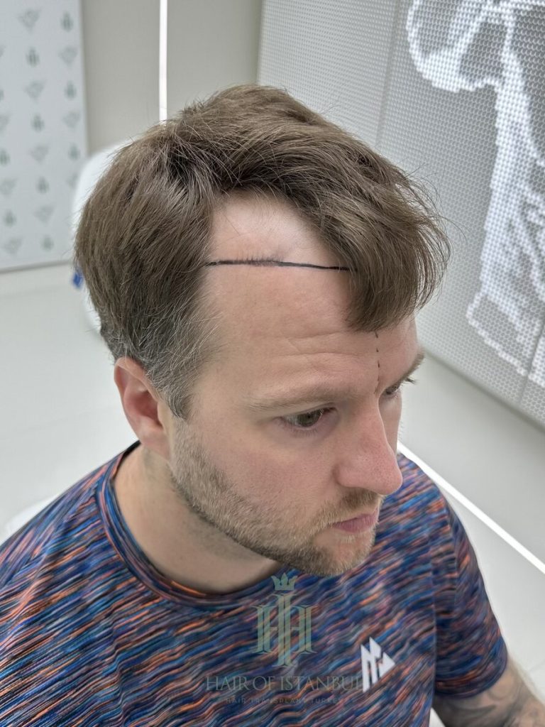Hair transplant result, 2,700 grafts, Hairline design (2) — Hair of Istanbul