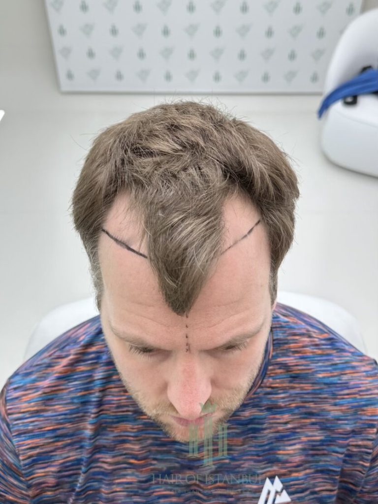 Hair transplant result, 2,700 grafts, Hairline design — Hair of Istanbul