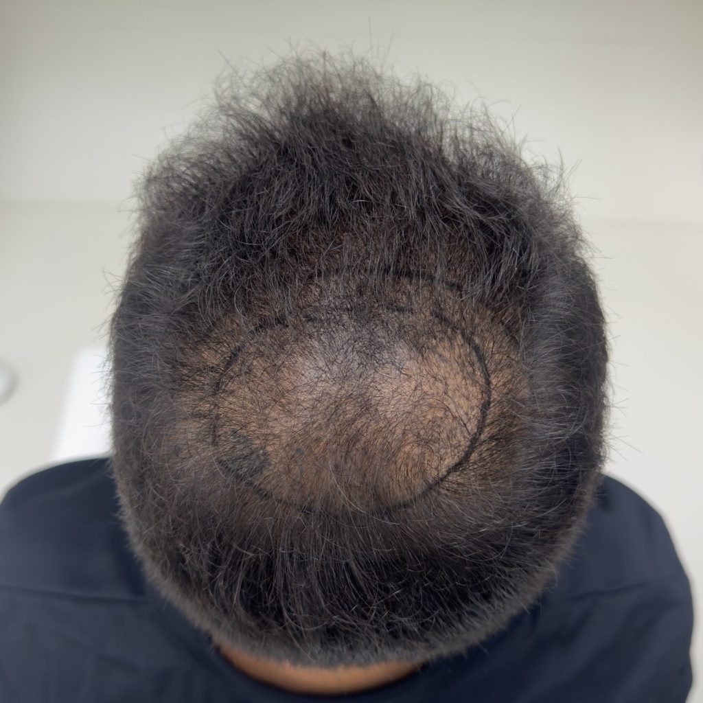 Hair transplant result, 4,500 grafts, Before (2) — Hair of Istanbul