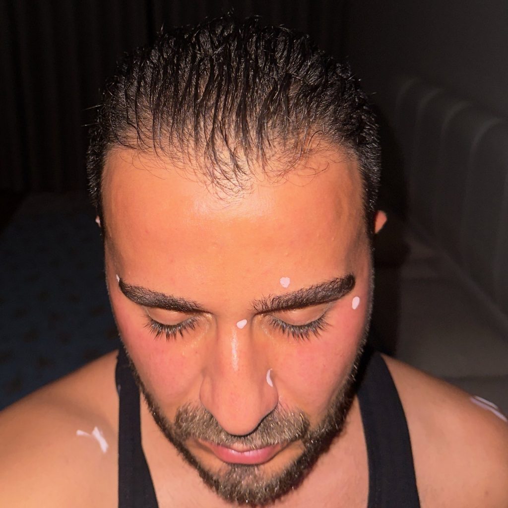 Hair transplant result, 4,500 grafts, Before — Hair of Istanbul