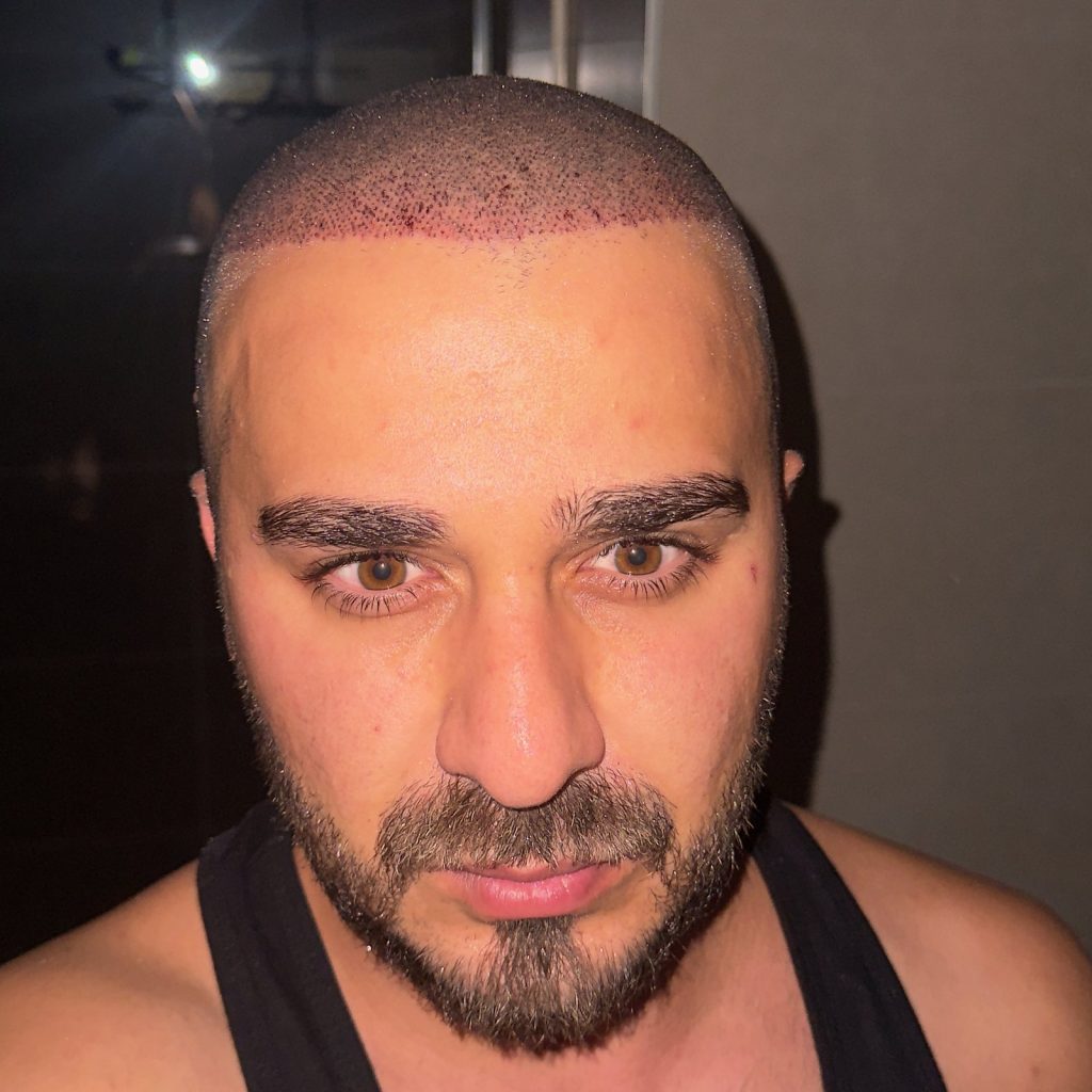 Hair transplant result, 4,500 grafts, Day 1 — Hair of Istanbul