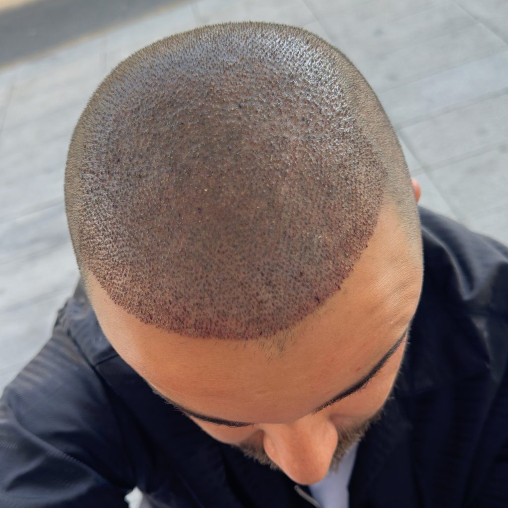 Hair transplant result, 4,500 grafts, Day 3 — Hair of Istanbul