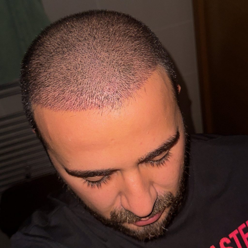 Hair transplant result, 4,500 grafts, Day 10 — Hair of Istanbul