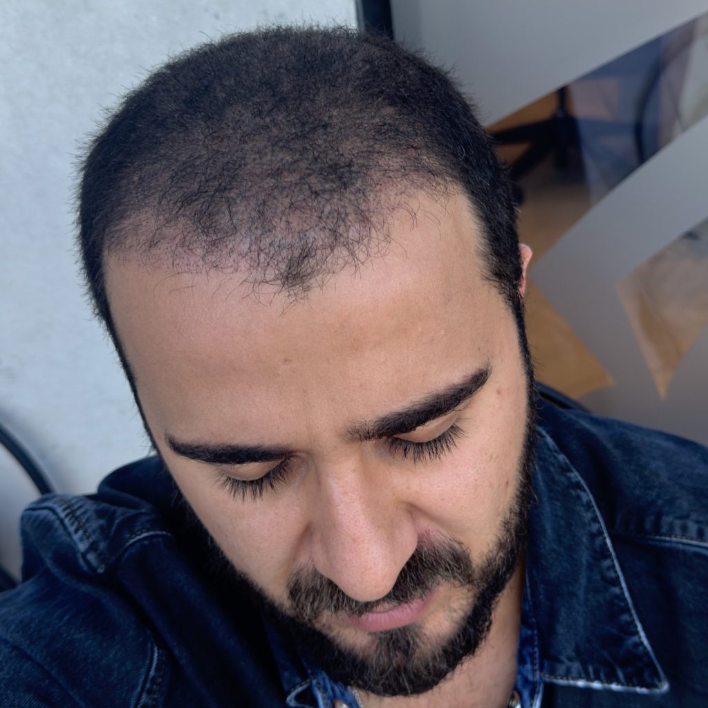 Hair transplant result, 4,500 grafts, Month 1 — Hair of Istanbul