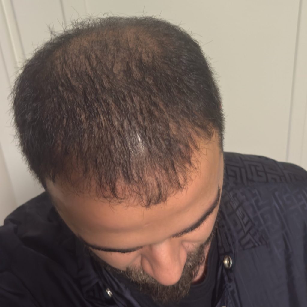 Hair transplant result, 4,500 grafts, Before & After — Hair of Istanbul