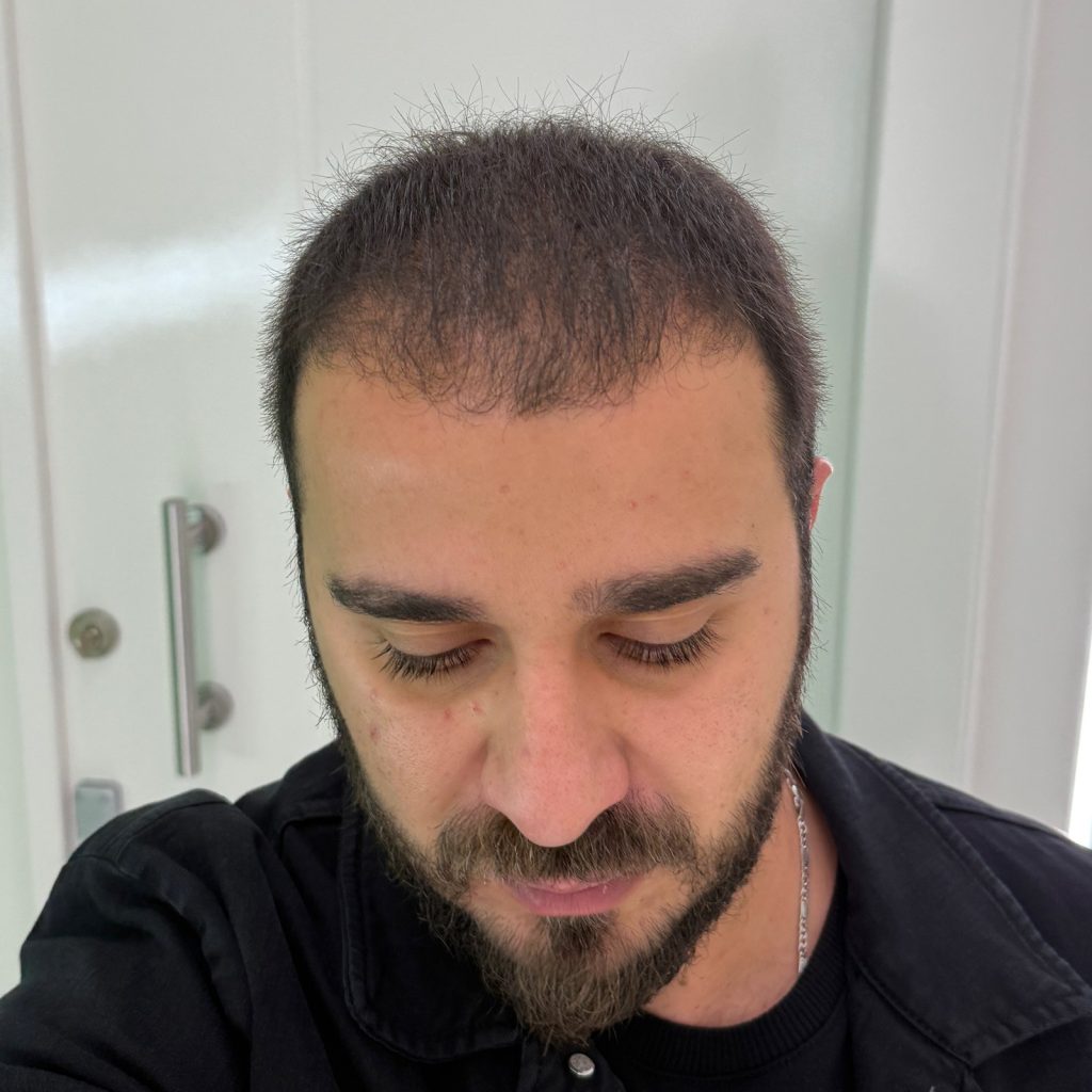 Hair transplant result, 4,500 grafts, Month 3 — Hair of Istanbul