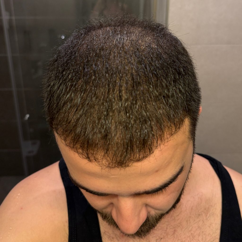 Hair transplant result, 4,500 grafts, Month 4 — Hair of Istanbul