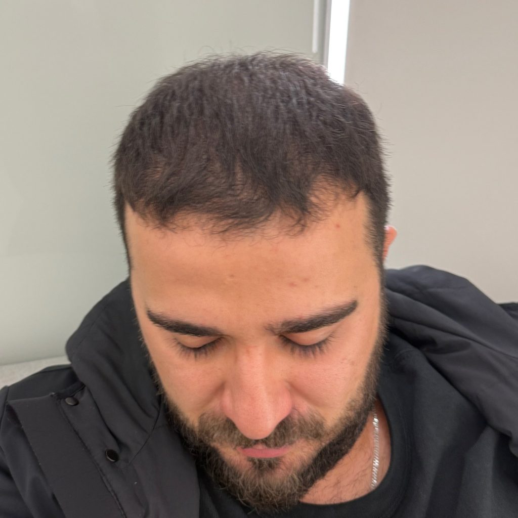 Hair transplant result, 4,500 grafts, Month 5 — Hair of Istanbul