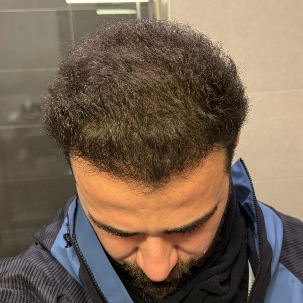 Hair transplant result, 4,500 grafts, Month 6 — Hair of Istanbul