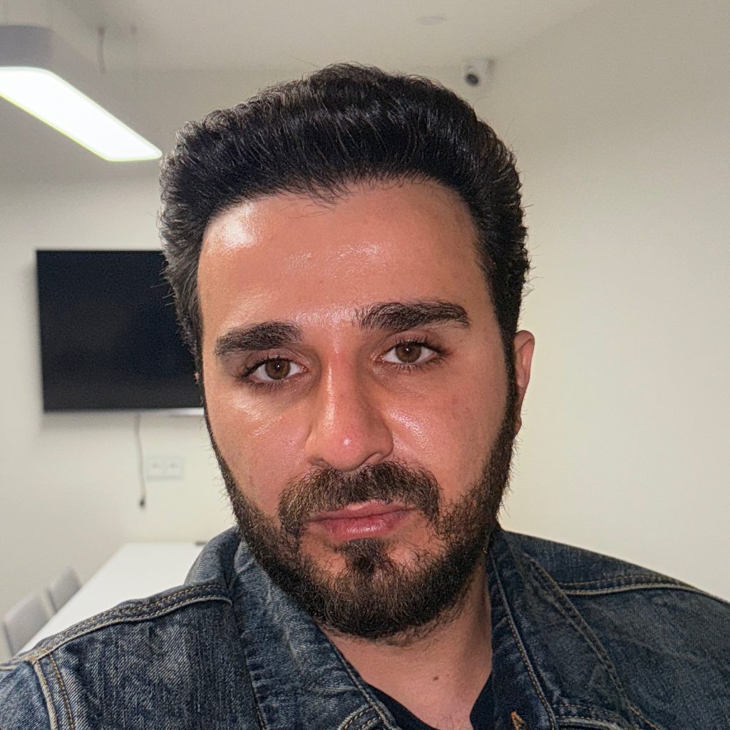 Hair transplant result, 4,500 grafts, Before & After (2) — Hair of Istanbul