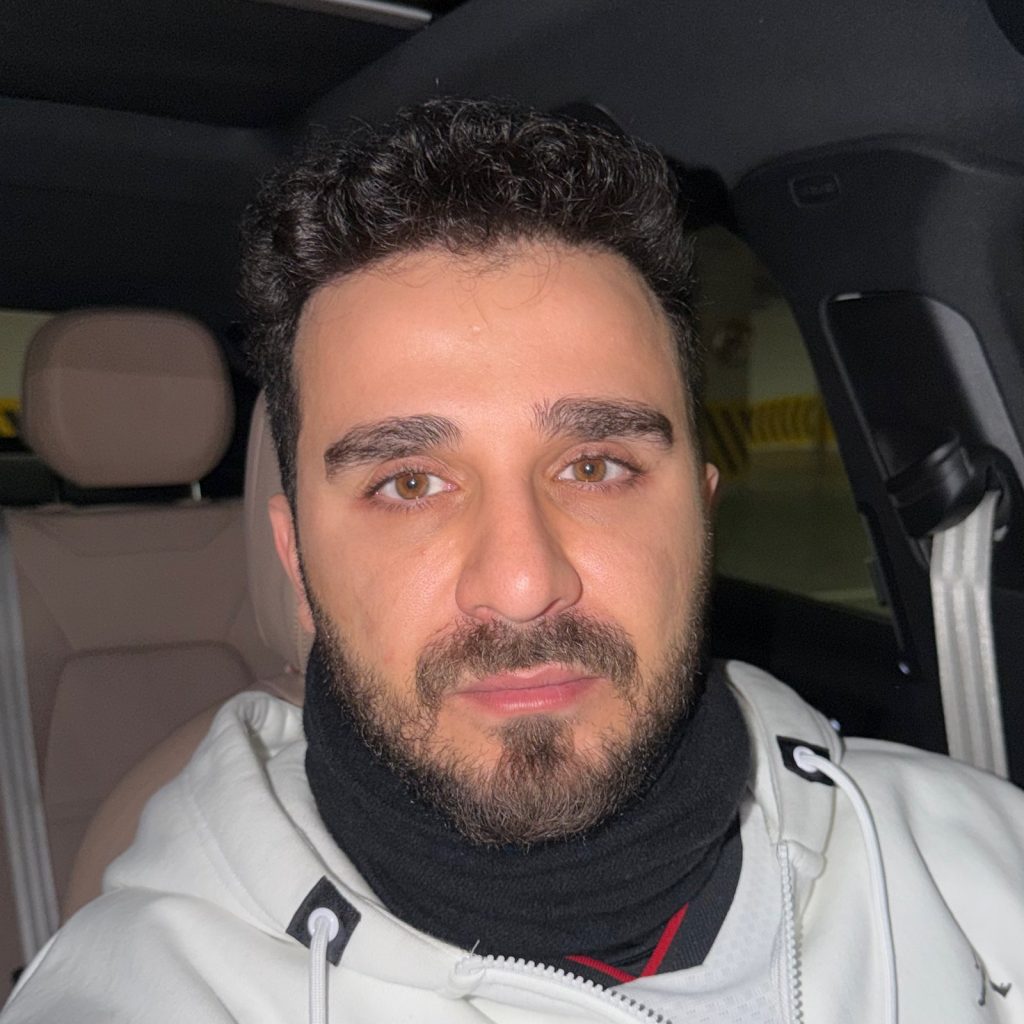 Hair transplant result, 4,500 grafts, Before & After (4) — Hair of Istanbul