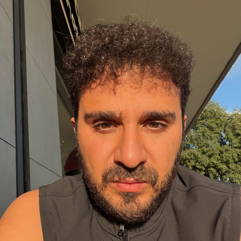 Hair transplant result, 4,500 grafts, Year 2 — Hair of Istanbul