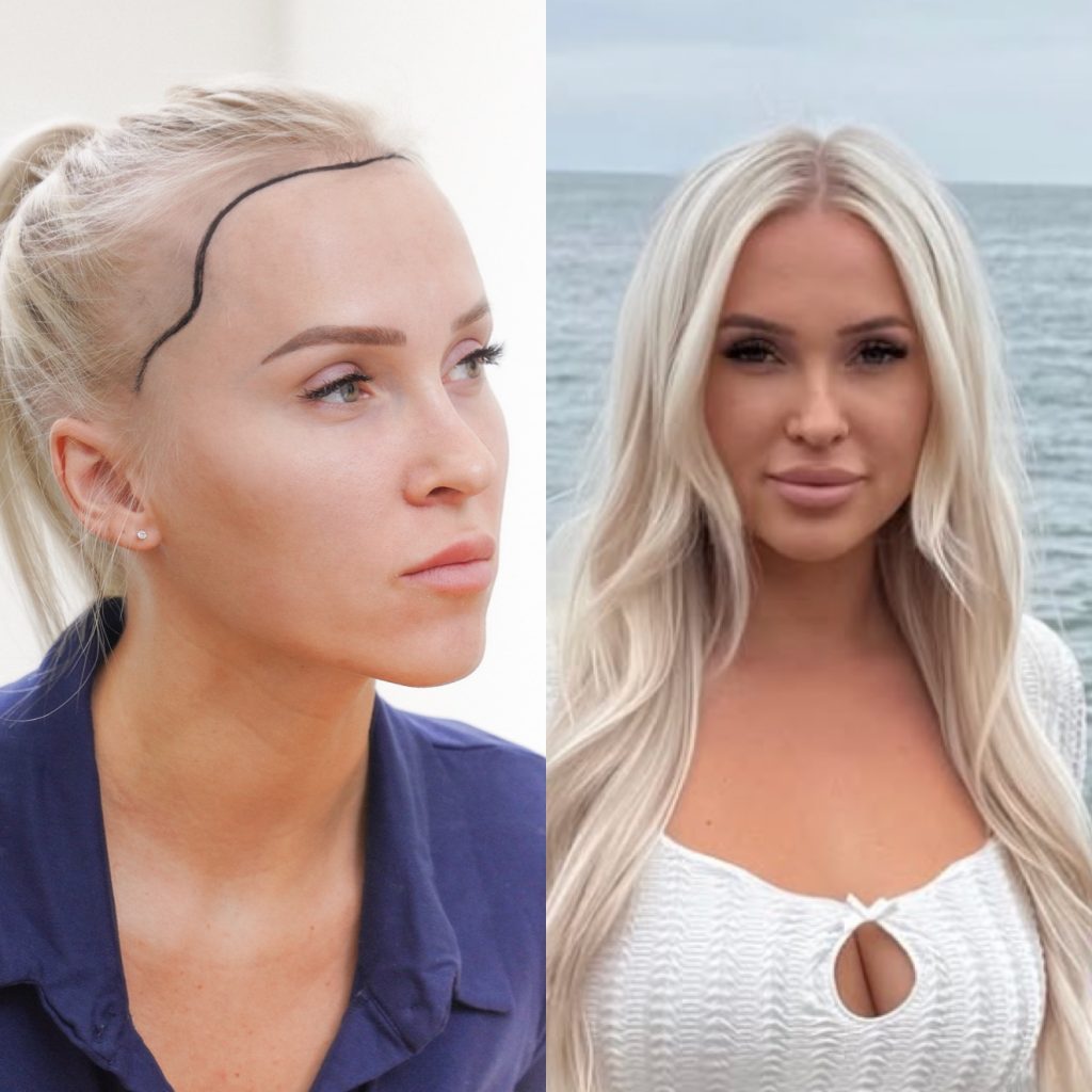 Women’s hair transplant result, 2,000 grafts, Before & After — Hair of Istanbul