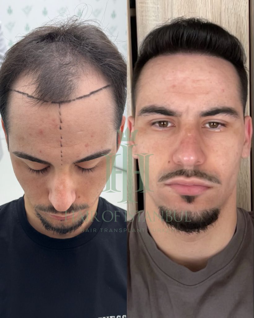 Hair transplant result, 3,100 grafts, Before & After — Hair of Istanbul
