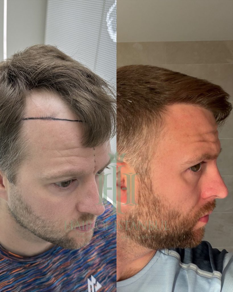 Hair transplant result, 2,700 grafts, Before & After — Hair of Istanbul