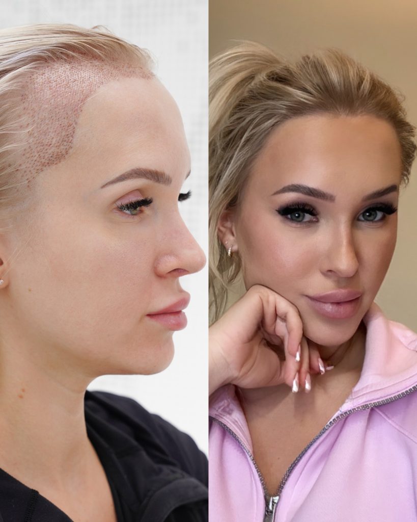 Women’s hair transplant result, 2,000 grafts, Before & After (2) — Hair of Istanbul
